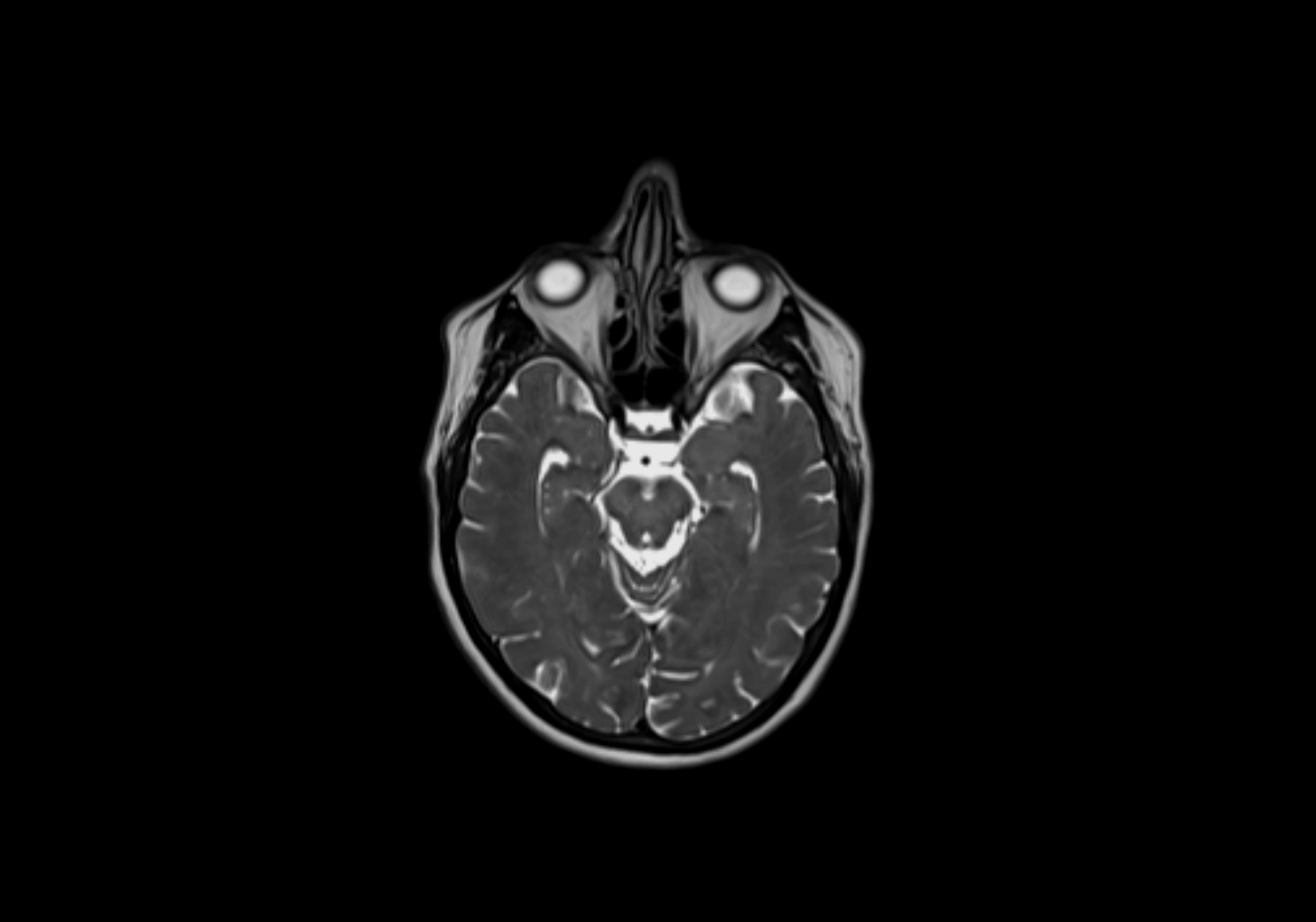 Neck axial  lymph node cross sectional MRI anatomy 3T MRI  image-img-00001-00005.webp